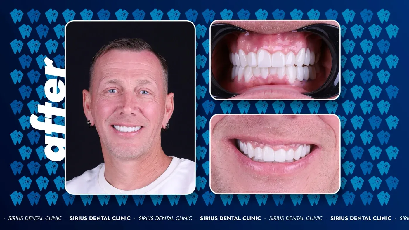 Keramikveneers nachher