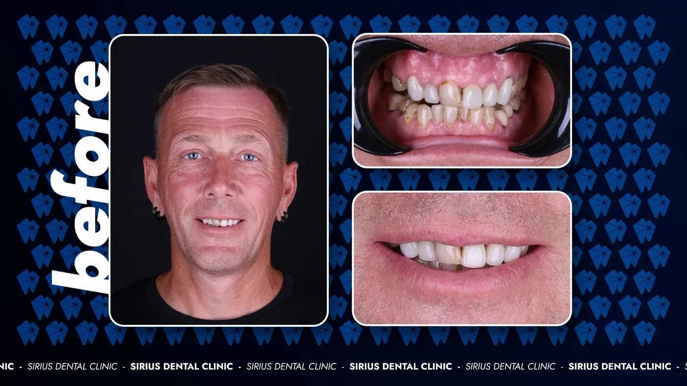 Keramikveneers vorher