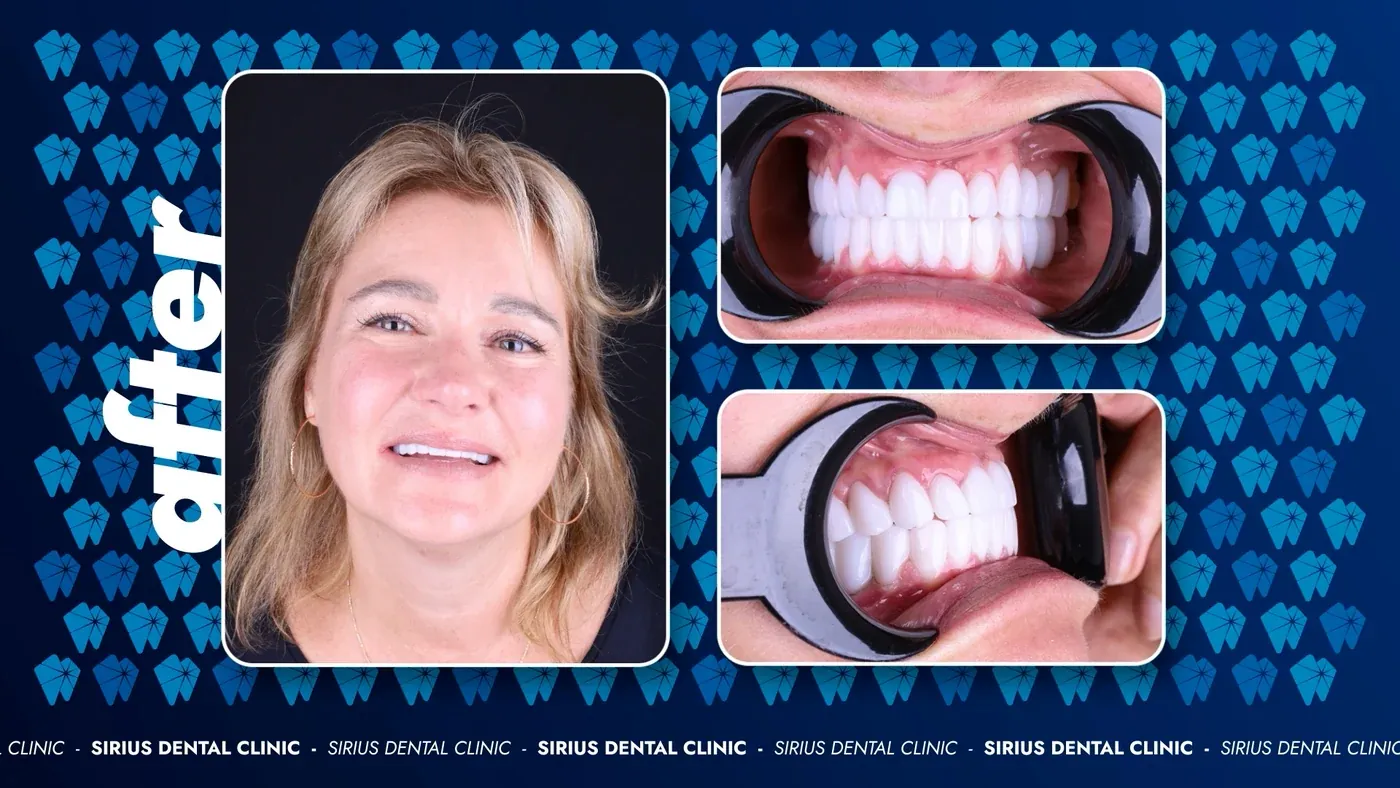 Smile Makeover nachher