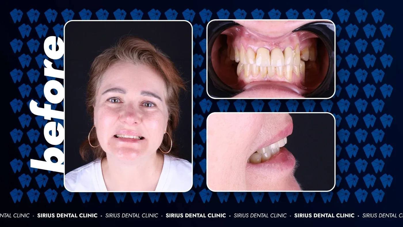 Smile Makeover vorher