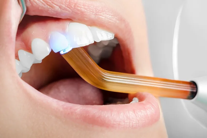 E-Max Veneer