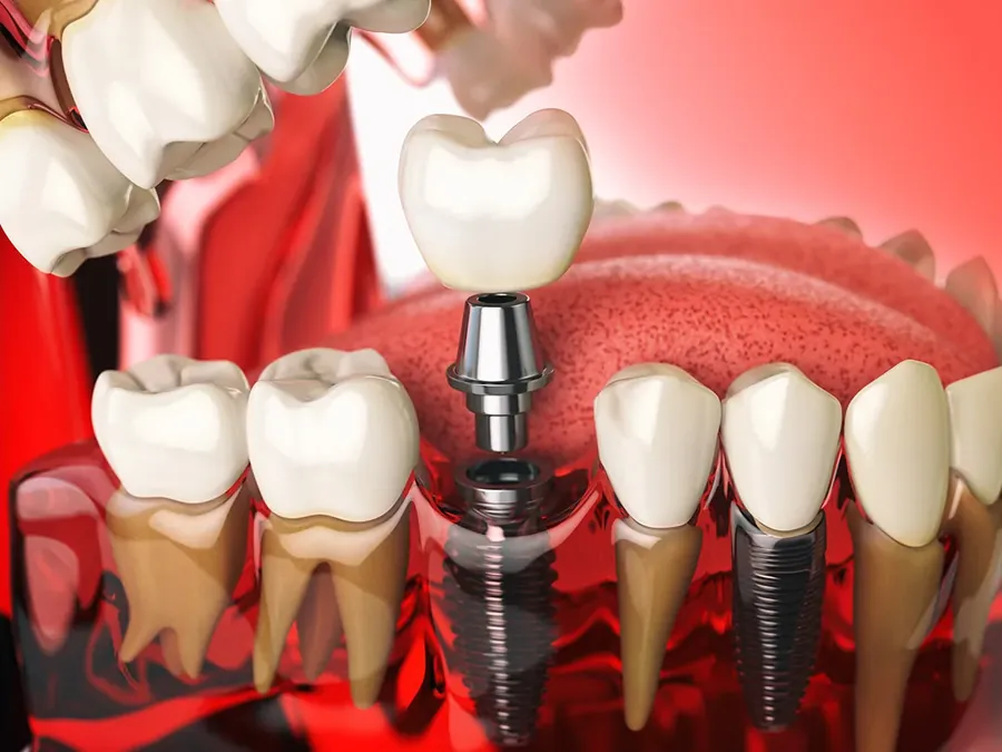 Implant or Bridge? Making the Right Choice